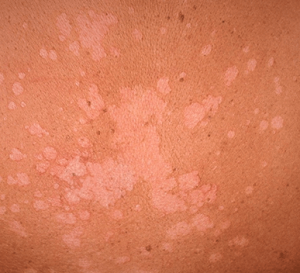 Tinea Versicolor - Walk-in Dermatology