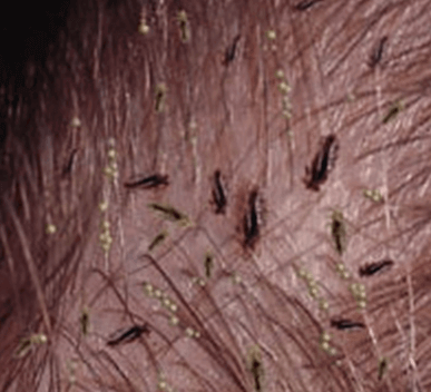 Head Lice - Walk-in Dermatology