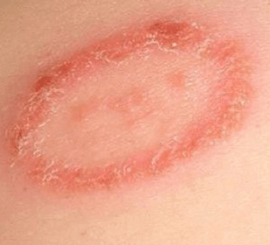 On skin ringworm How to