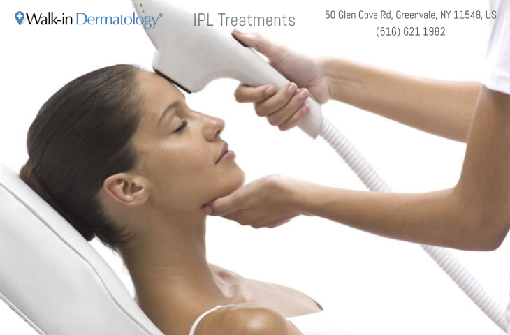 IPL photofacial treatment