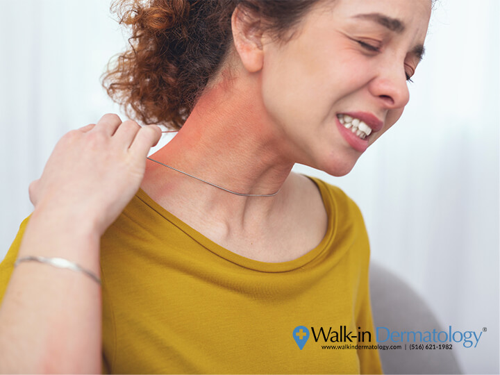 Fake Jewelry Allergy | Skin Rashes | Walk-in Dermatology