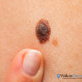 What Happens if you Accidentally Scratch Off a Mole? | Walk-in Dermatology