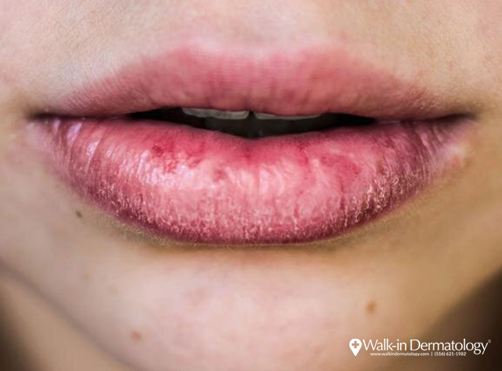 Walk-in Dermatology Why are my Lips Always Chapped?