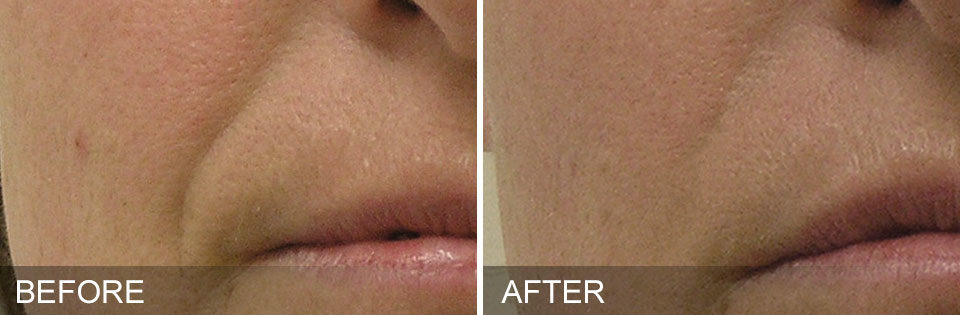 a close-up photo of a face before and after a HydraFacial