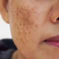Close-up of a woman's face with melasma