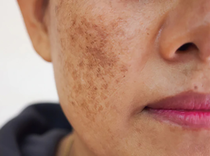 Close-up of a woman's face with melasma