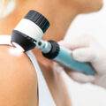 Dermatologist using a dermatoscope to check for skin cancer on a patient