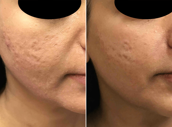 before and after photo of a patient's face after an RF microneedling session
