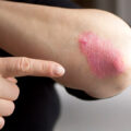 Person pointing at Psoriasis at there elbow