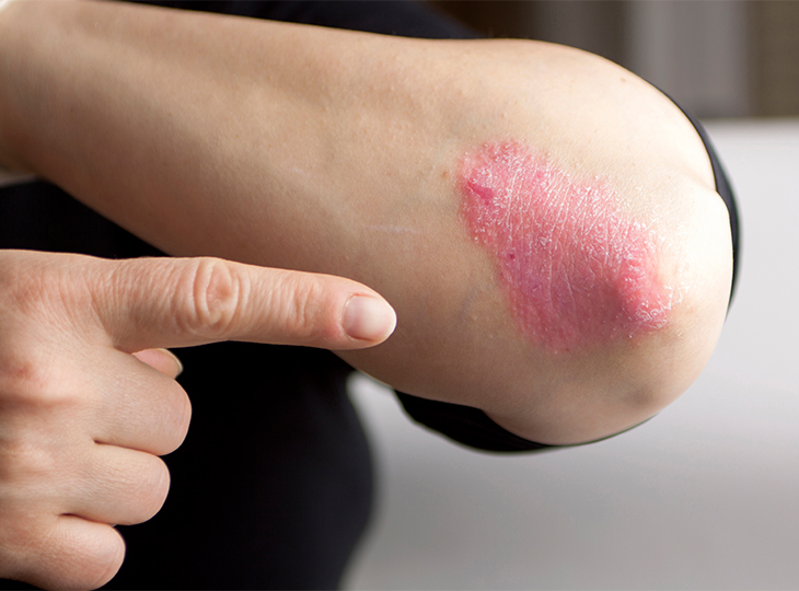 Person pointing at Psoriasis at there elbow