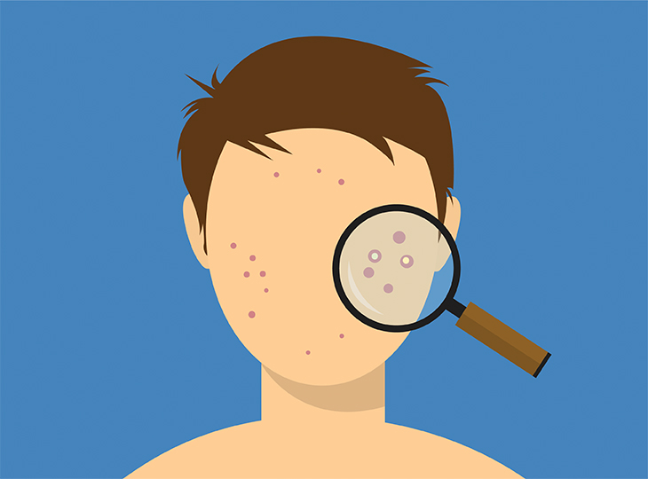 Illustration of a Man with Acne