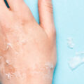Dry hand with skin peeling off on-top of a blue background