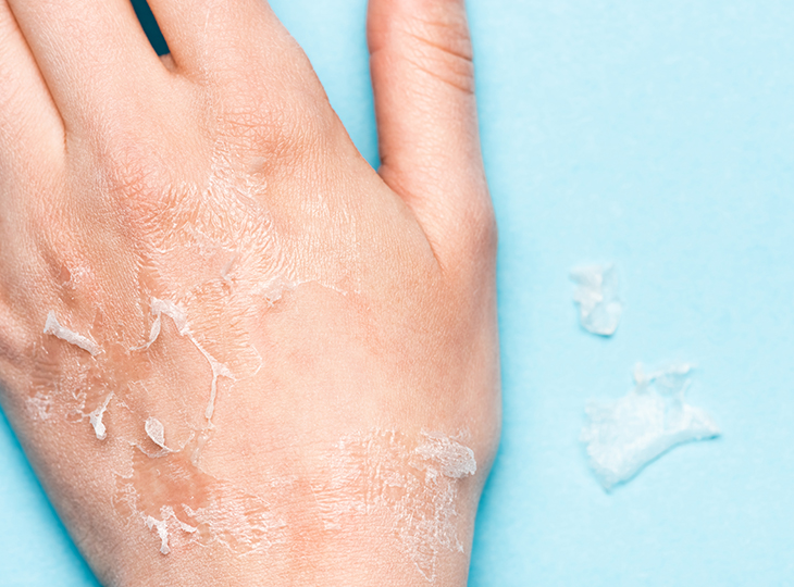 Dry hand with skin peeling off on-top of a blue background