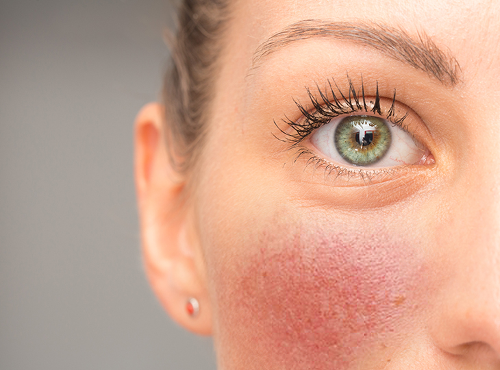 Close-up of a woman with Rosacea on her cheeks