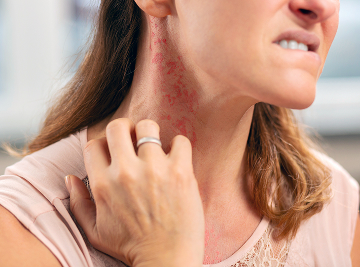 a woman scratching a rash on her neck